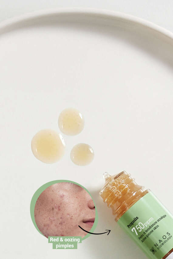 ¿Qué causa el acné?